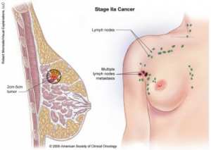 පියයුරු පිළිකාවට ප්‍රතිකාර කරන විදිය