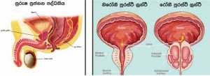 පූරංස්ථ ග්‍රන්ථි ඉදිමීම කියන්නේ කුමක් ද?